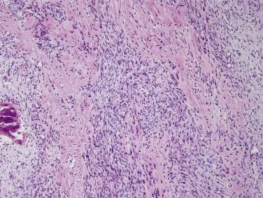 FIG. 24.33, Fibro-osseous pseudotumor. This fasciitis-like lesion is associated with irregular deposits of osteoid and bone.