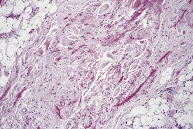 FIG. 24.34, Elastofibroma. Note brightly eosinophilic elastic fibers.