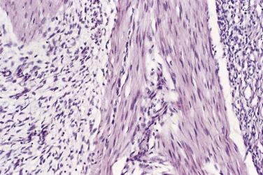 FIG. 24.37, Fibrous hamartoma of infancy. The fascicular component is myofibroblastic. The myxoid areas appear primitive.