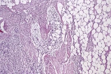 FIG. 24.36, Fibrous hamartoma of infancy. All four components are evident in this field.