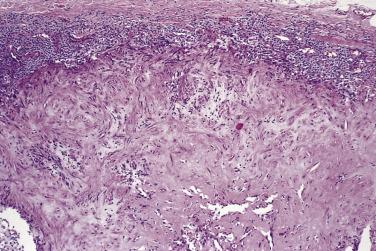 FIG. 24.38, Infantile myofibromatosis. Typically abrupt transition from myofibroblastic spindle cell area to more primitive rounded cells at the periphery.