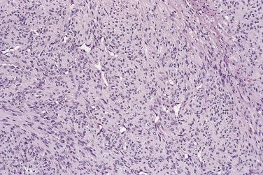 FIG. 24.39, Infantile myofibromatosis. In this case the less differentiated areas consist of rounded cells with eosinophilic cytoplasm arranged around branching vessels.