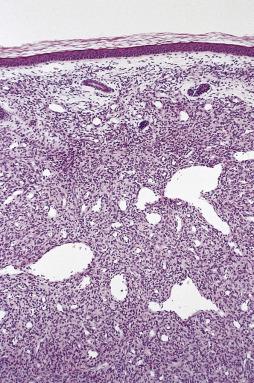 FIG. 24.40, Infantile myofibromatosis. Primitive examples like this have often been labeled infantile hemangiopericytoma .