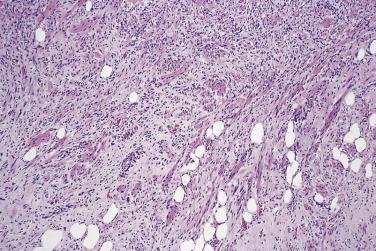 FIG. 24.4, Myolipoma. Typical admixture of smooth muscle cells and adipocytes.