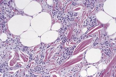 FIG. 24.6, Spindle cell lipoma. Note the typical admixture of mature adipocytes, bland, undifferentiated spindle cells, and hyaline collagen bundles.