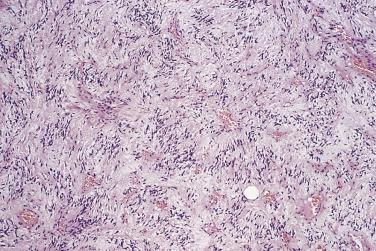 FIG. 24.7, Spindle cell lipoma. Lesions showing spindle cell predominance may mimic schwannoma.