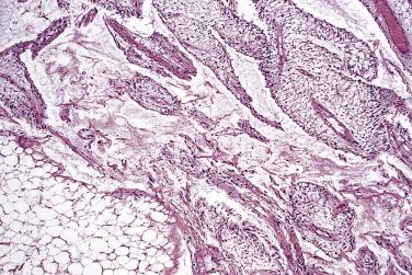 FIG. 24.9, Spindle cell lipoma. Marked myxoid degeneration may lead to a villiform, lymphangiomatoid appearance.