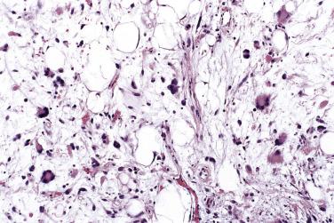 FIG. 24.10, Pleomorphic lipoma. Typical floret-type giant cells and hyperchromatic stromal cells.