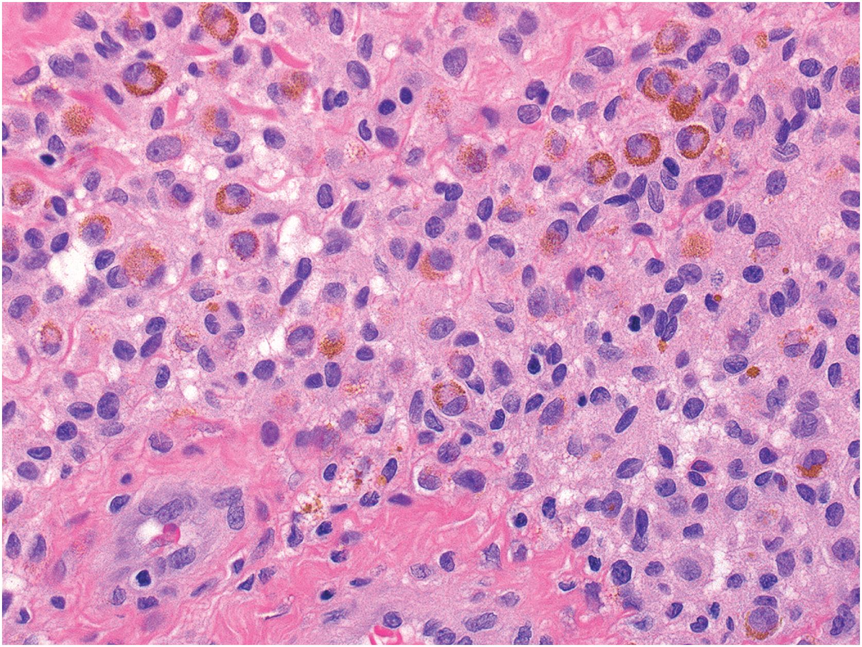 Fig. 13.11, Tenosynovial giant cell tumor. The large mononuclear cells with abundant pale cytoplasm, some of also which have a ring of cytoplasmic hemosiderin deposition, are thought to be the neoplastic cell.