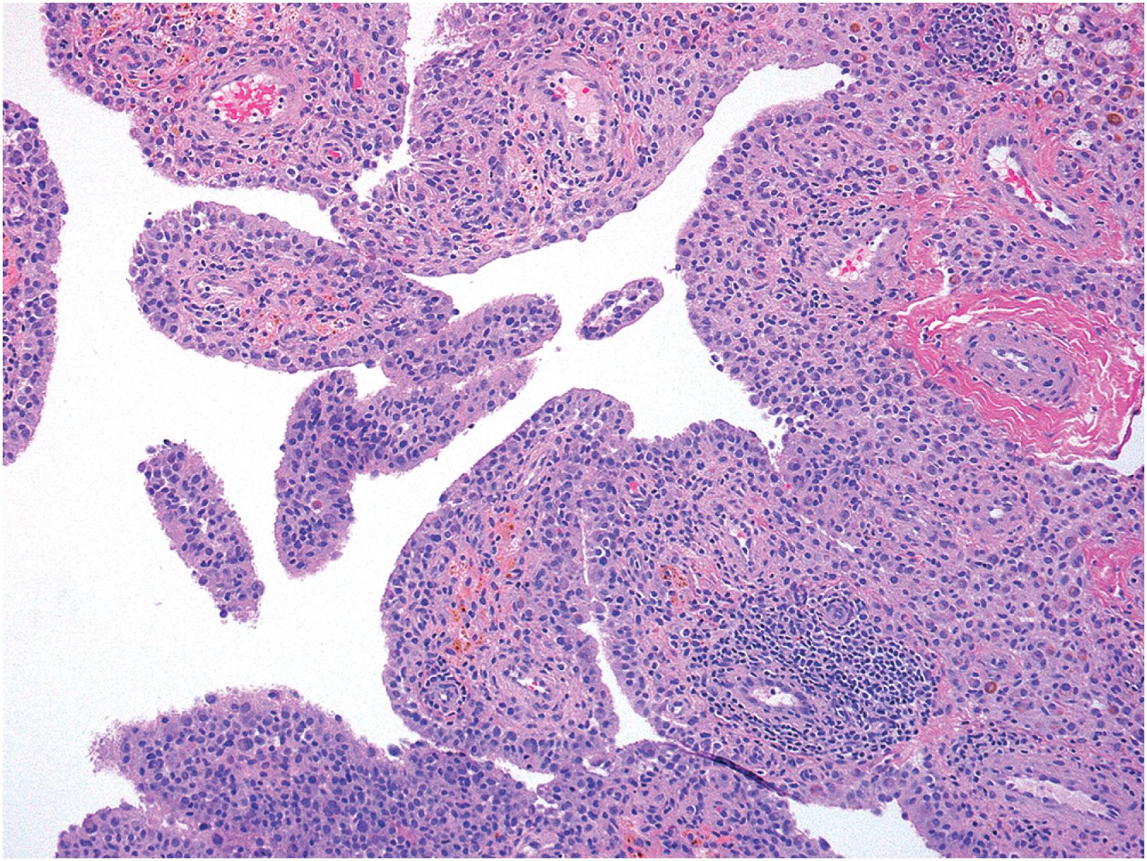 Fig. 13.12, Diffuse tenosynovial giant cell tumor. Microscopically, tumor cells diffusely infiltrate the subsynovial connective tissue. An admixture of epithelioid mononuclear cells, siderophages, and foamy histiocytes is evident, and scattered lymphocytic aggregates are present.