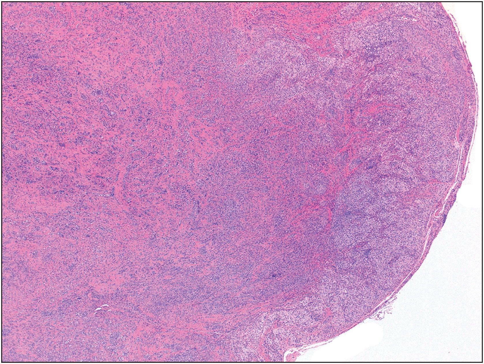 Fig. 13.13, Localized tenosynovial giant cell tumor is a lobulated mass composed of an admixture of osteoclast-type giant cells and mononuclear cells in a variably prominent collagenous stroma.