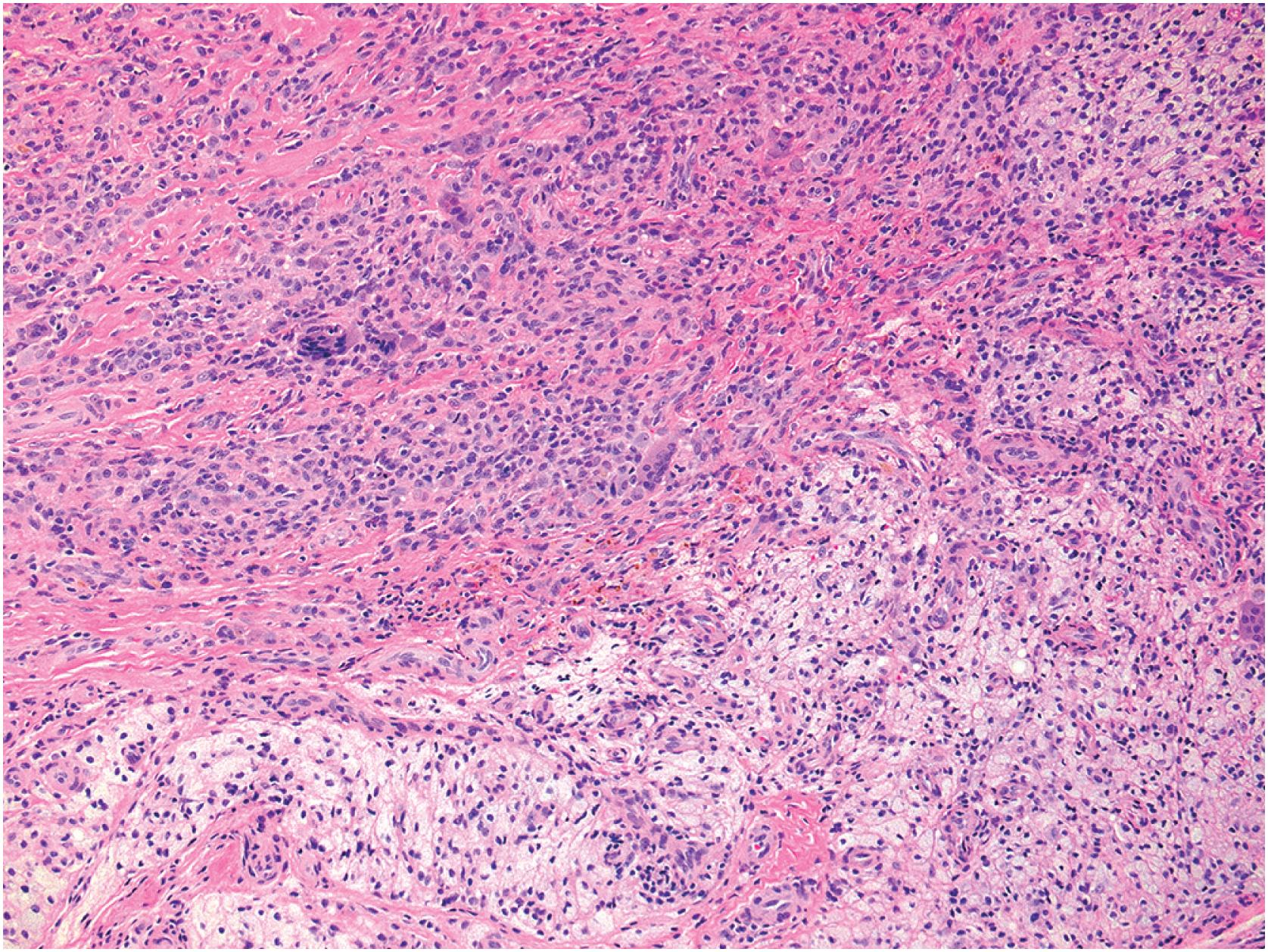 Fig. 13.14, Localized tenosynovial giant cell tumor. Alternating sheets of foamy histiocytes and mononuclear cells with only a few siderophages and osteoclast-type giant cells in a fibrous stroma.