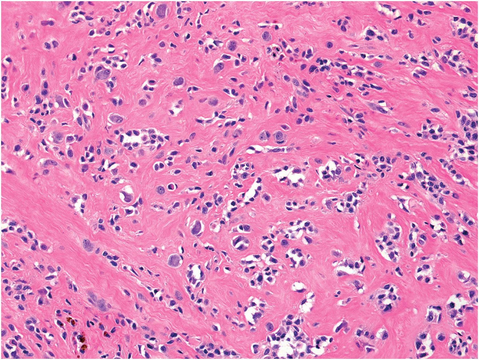 Fig. 13.15, Localized tenosynovial giant cell tumor. This tumor is largely hyalinized, with scattered nests of mononuclear cells and scarce giant cells.