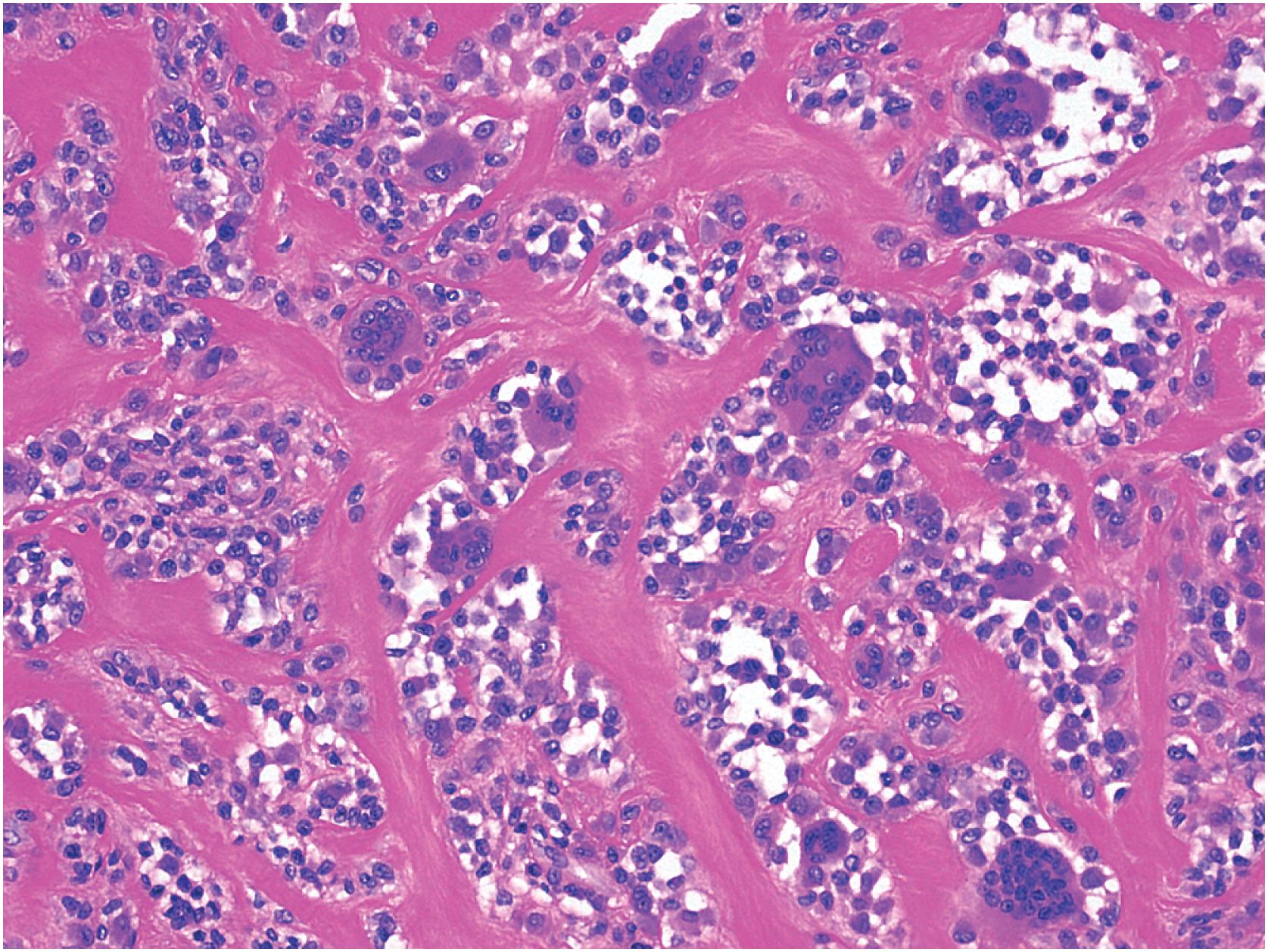 Fig. 13.16, Localized tenosynovial giant cell tumor with numerous osteoclast-type giant cells.