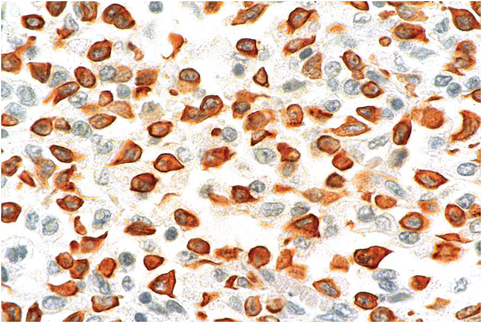 Fig. 13.17, Diffuse tenosynovial giant cell tumor. Immunohistochemical stain for desmin shows numerous positive cells.