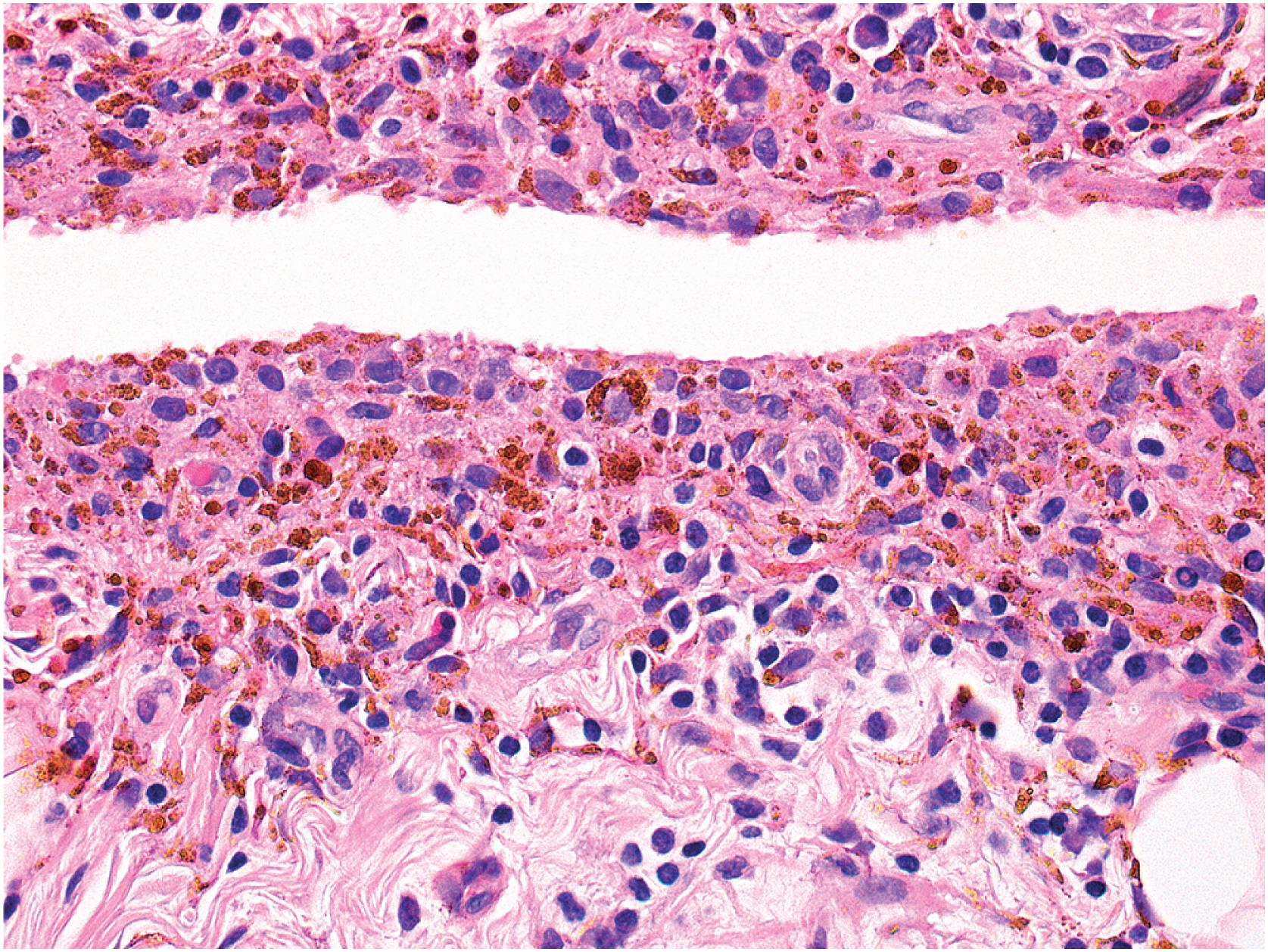 Fig. 13.18, Hemosiderotic synovitis showing hemosiderin deposition within synoviocytes and subsynovial tissue.