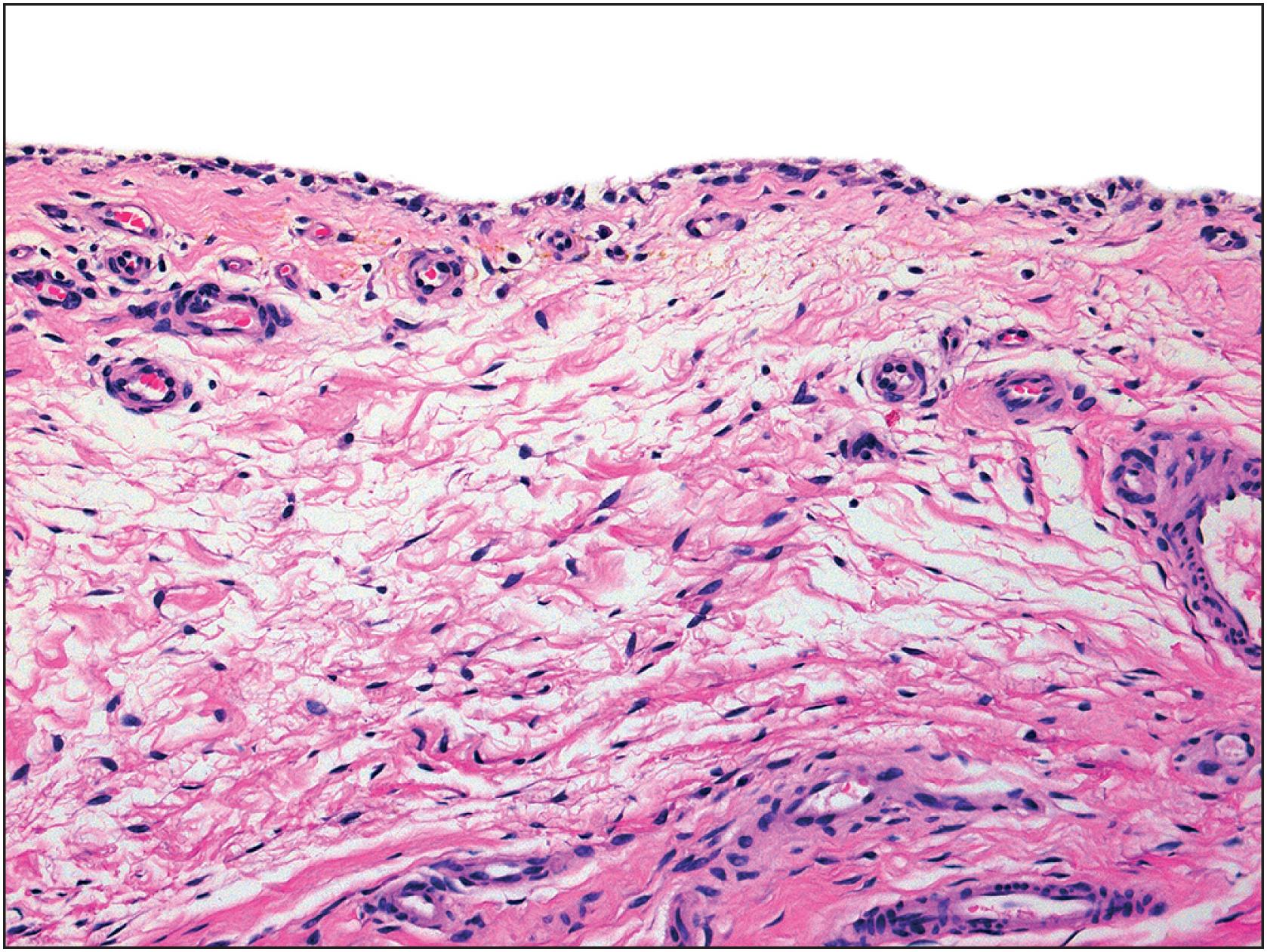 Fig. 13.2, Normal synoviocytes overlying loose connective tissue.