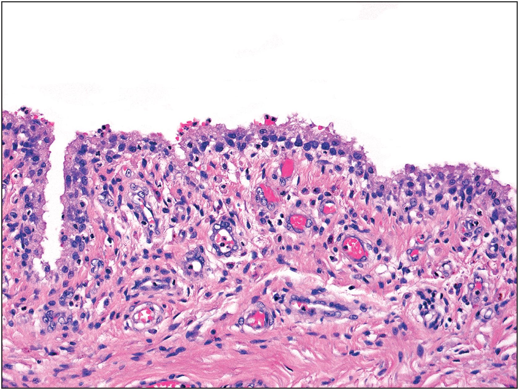 Fig. 13.3, Reactive synovium showing plump synoviocytes with abundant cytoplasm overlying connective tissue with prominent dilated capillaries.