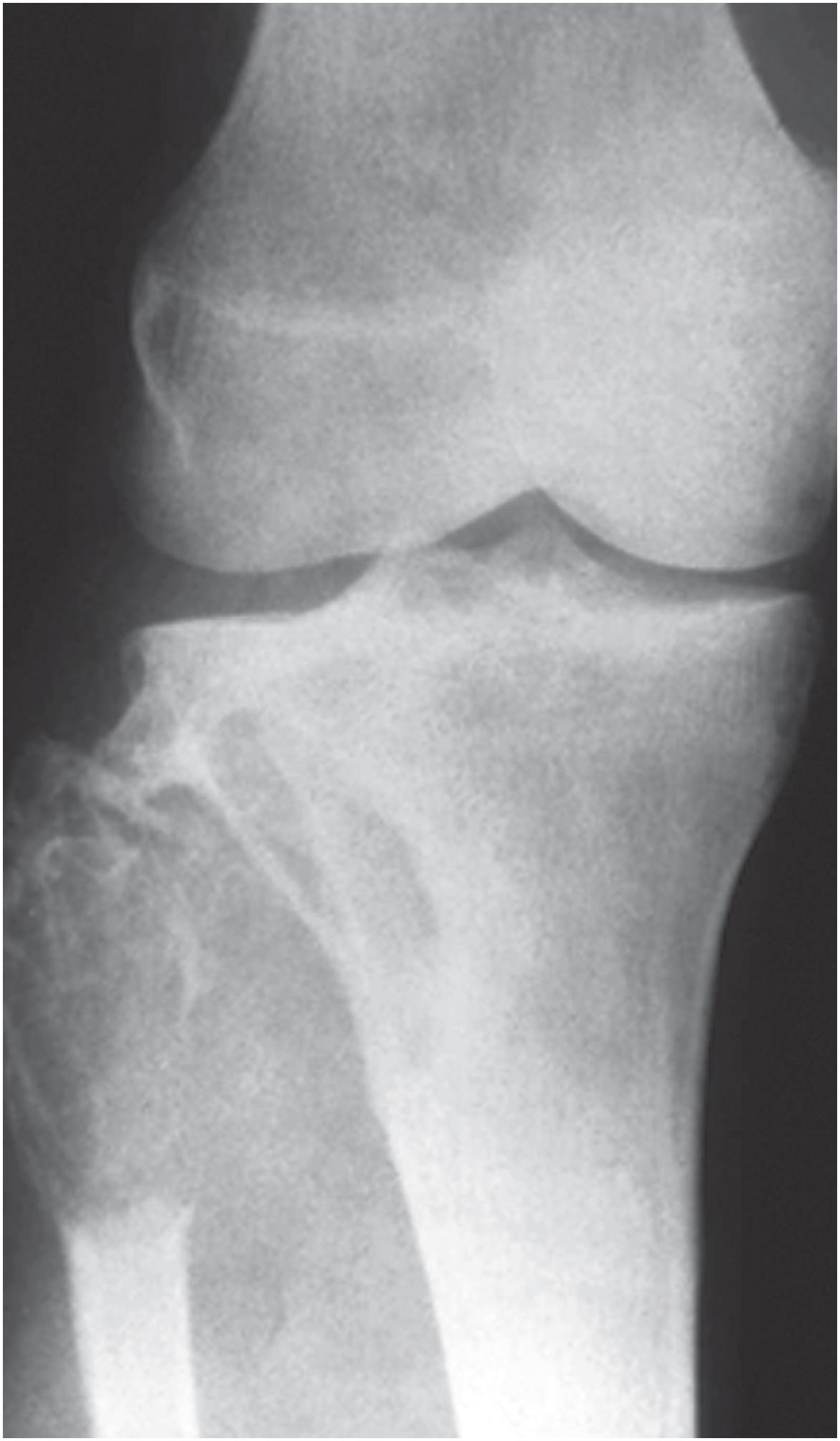 Fig. 13.5, Plain radiograph showing destructive changes of fibula and tibia from a diffuse tenosynovial giant cell tumor arising in the tibiofibular joint.