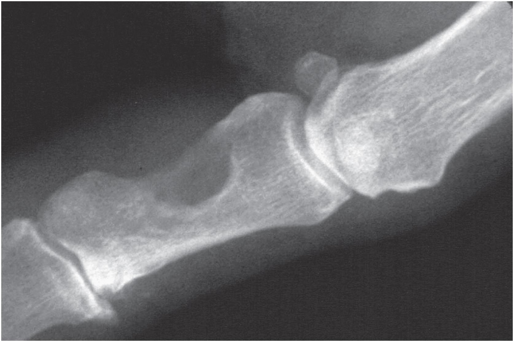 Fig. 13.6, Localized tenosynovial giant cell tumor. Plain radiograph shows a soft tissue mass and scalloping of the underlying bone