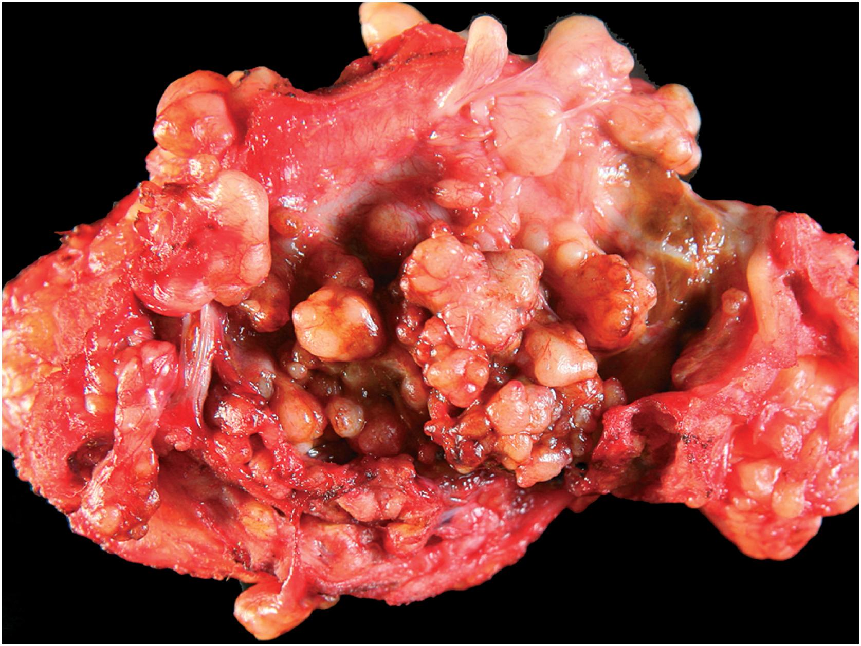 Fig. 13.7, Intra-articular diffuse tenosynovial giant cell tumor. Gross photo showing diffuse nodularity and discoloration of the synovium.