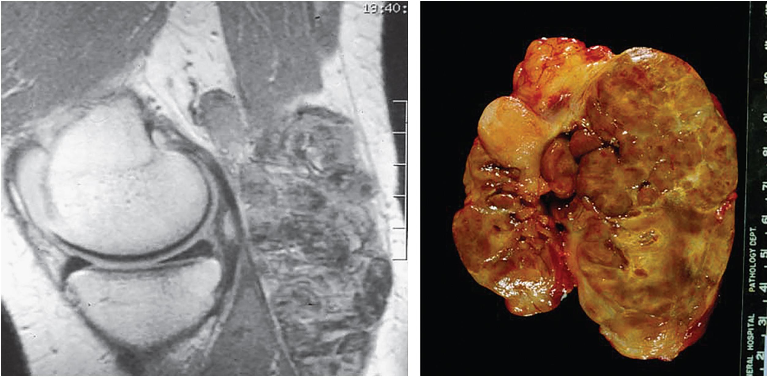 Fig. 13.8, Magnetic resonance imaging and a gross image of diffuse tenosynovial giant cell tumor involving the knee joint with extension into a Baker’s cyst. On cross section, it has the characteristic brown, fibrous, and yellow areas typical of tenosynovial giant cell tumor.