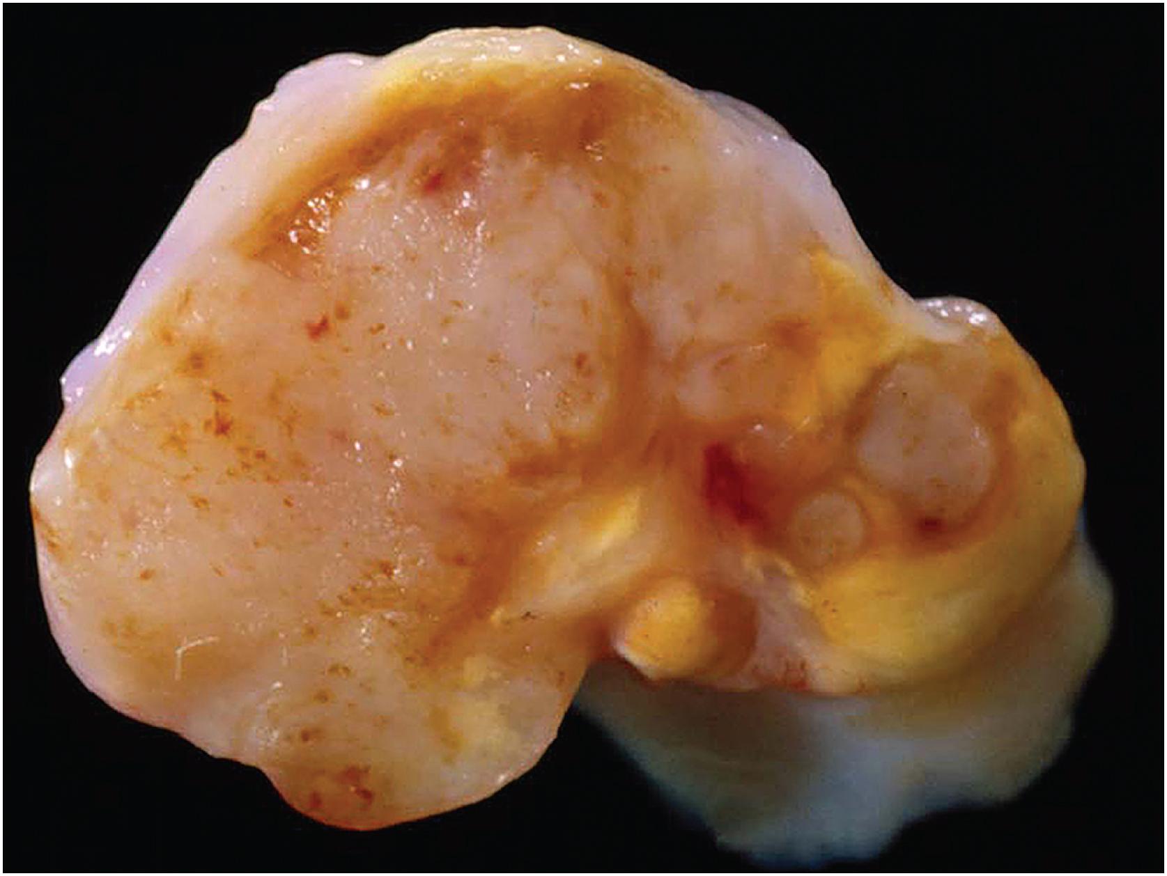 Fig. 13.10, Localized tenosynovial giant cell tumor. Cross sections showing brown, grey, and yellow areas.