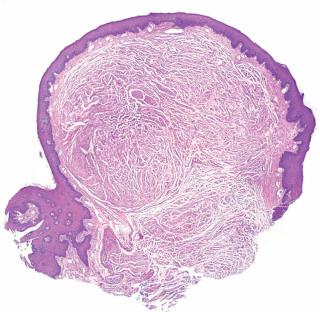 Fig. 1, Mucosal neuroma.