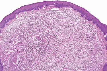 Fig. 2, Mucosal neuroma.