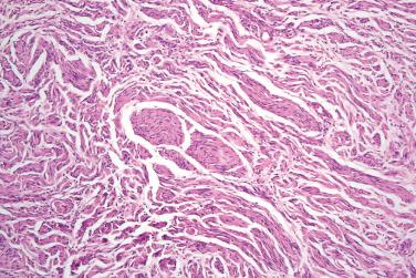 Fig. 3, Mucosal neuroma.