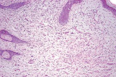 Fig. 1, Primary cutaneous ganglioneuroma.