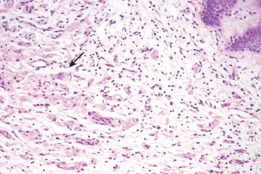 Fig. 2, Primary cutaneous ganglioneuroma.