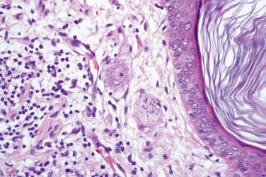 Fig. 4, Primary cutaneous ganglioneuroma.