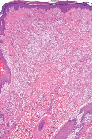 Fig. 1, Congenital neurovascular hamartoma.