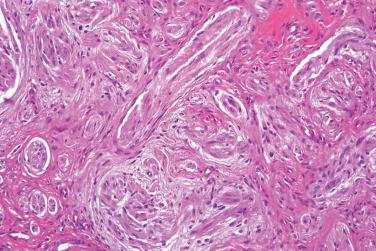 Fig. 2, Congenital neurovascular hamartoma.