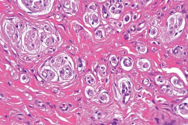 Fig. 3, Congenital neurovascular hamartoma.