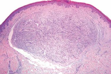 Fig. 1, Solitary circumscribed neuroma.