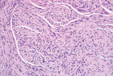 Fig. 2, Solitary circumscribed neuroma.