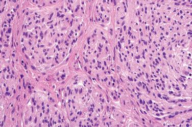 Fig. 3, Solitary circumscribed neuroma.