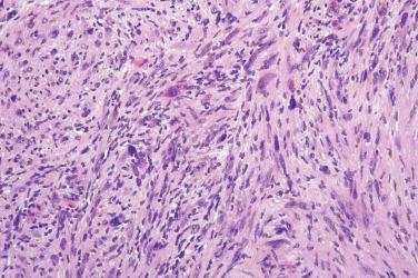 Fig. 5, Solitary circumscribed neuroma.