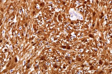 Fig. 6, Solitary circumscribed neuroma.