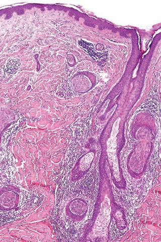 Fig. 1, Epithelial sheath neuroma.