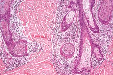 Fig. 2, Epithelial sheath neuroma.