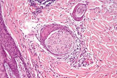 Fig. 3, Epithelial sheath neuroma.