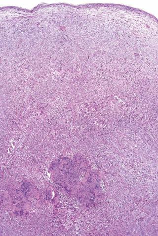 Fig. 1, Conventional schwannoma.