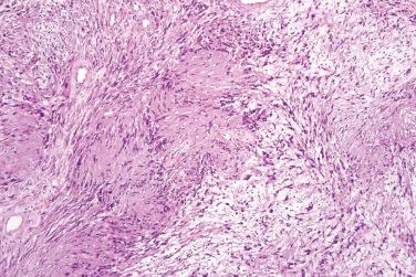 Fig. 2, Conventional schwannoma.