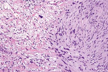 Fig. 4, Conventional schwannoma.