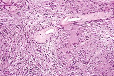 Fig. 5, Conventional schwannoma.