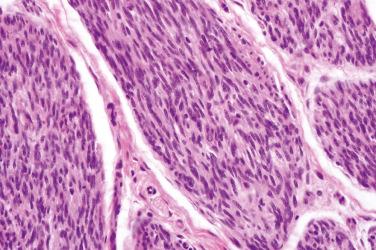 Fig. 3, Plexiform schwannoma.