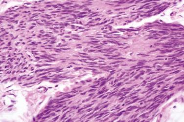 Fig. 4, Plexiform schwannoma.